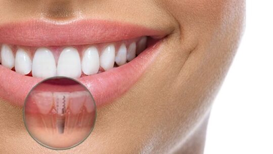 Saiba 4 dicas para a higiene correta de seu implante dentário