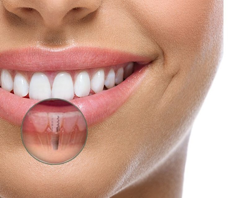 4 dicas para a higiene correta de seu implante dentário